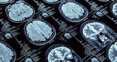 Results of a an MRI show images of a brain.
