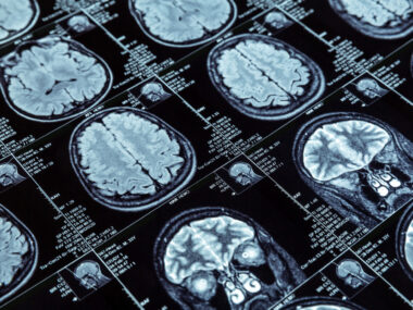 Results of a an MRI show images of a brain.